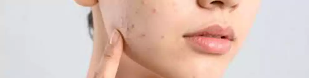 Anti Acne